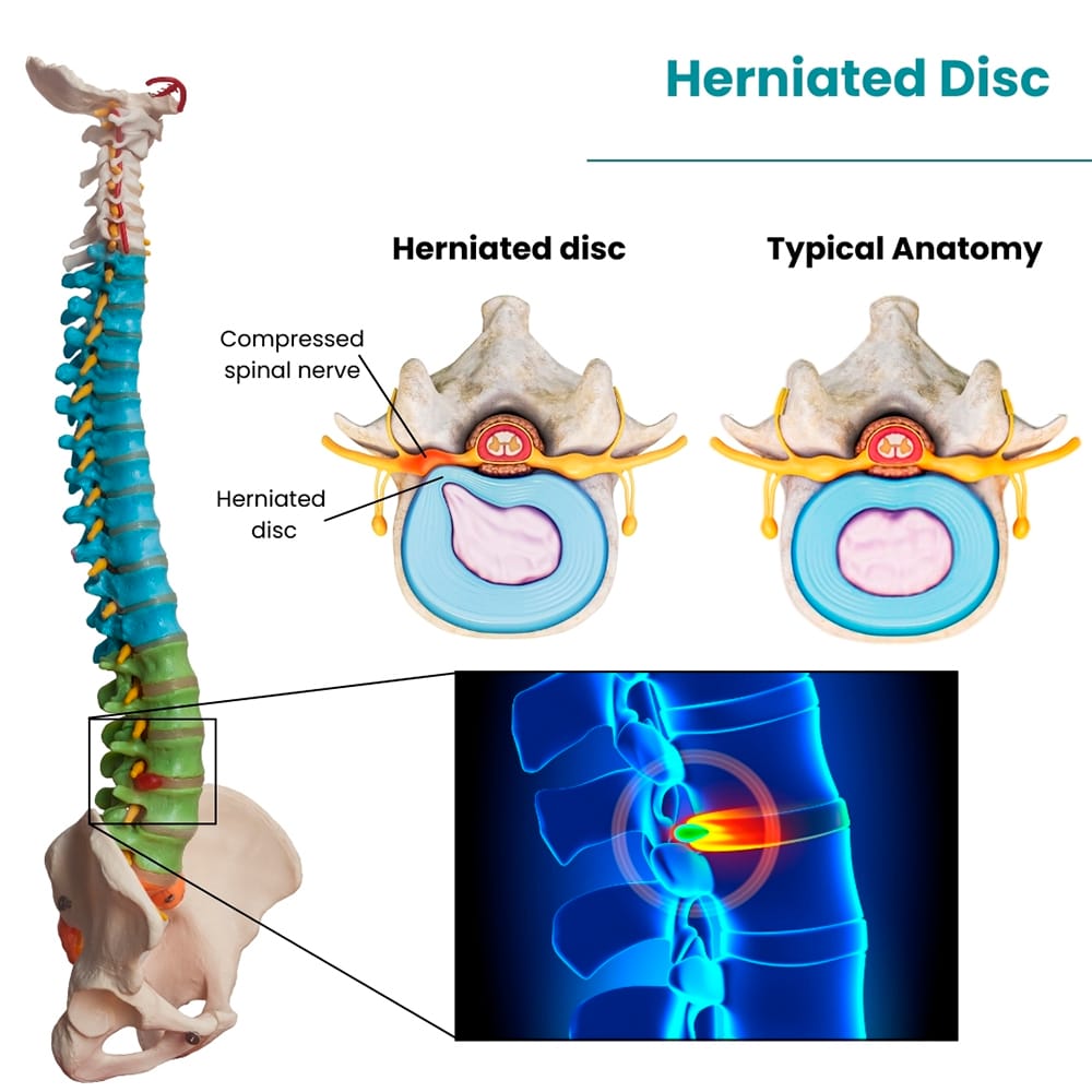 Herniated Disc