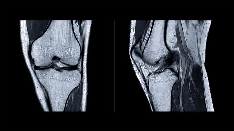 Knee MRI images showing the ACL region and surrounding knee structures in coronal and sagittal views.