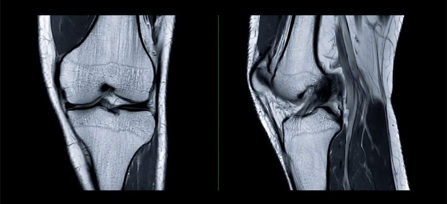 Knee MRI Results Interpretation