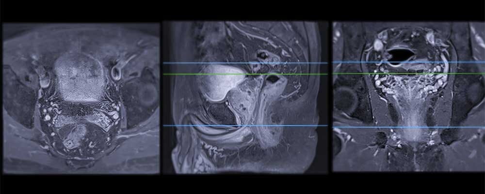 Prostate MRI Results Interpretation