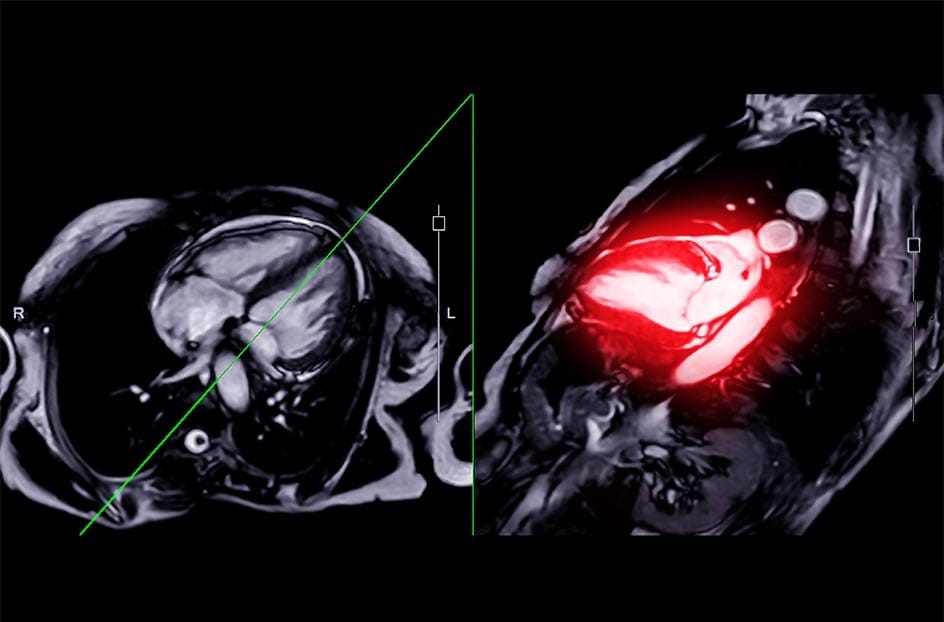 Cardiac MRI heart scan at Manhattan MRI in Midtown Manhattan