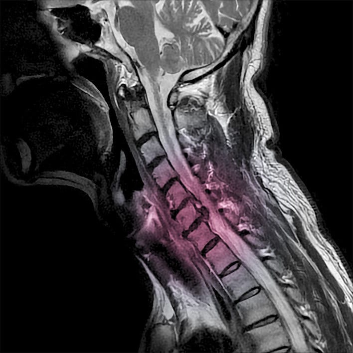 Cervical spine MRI showing a herniated disc and surrounding spinal structures