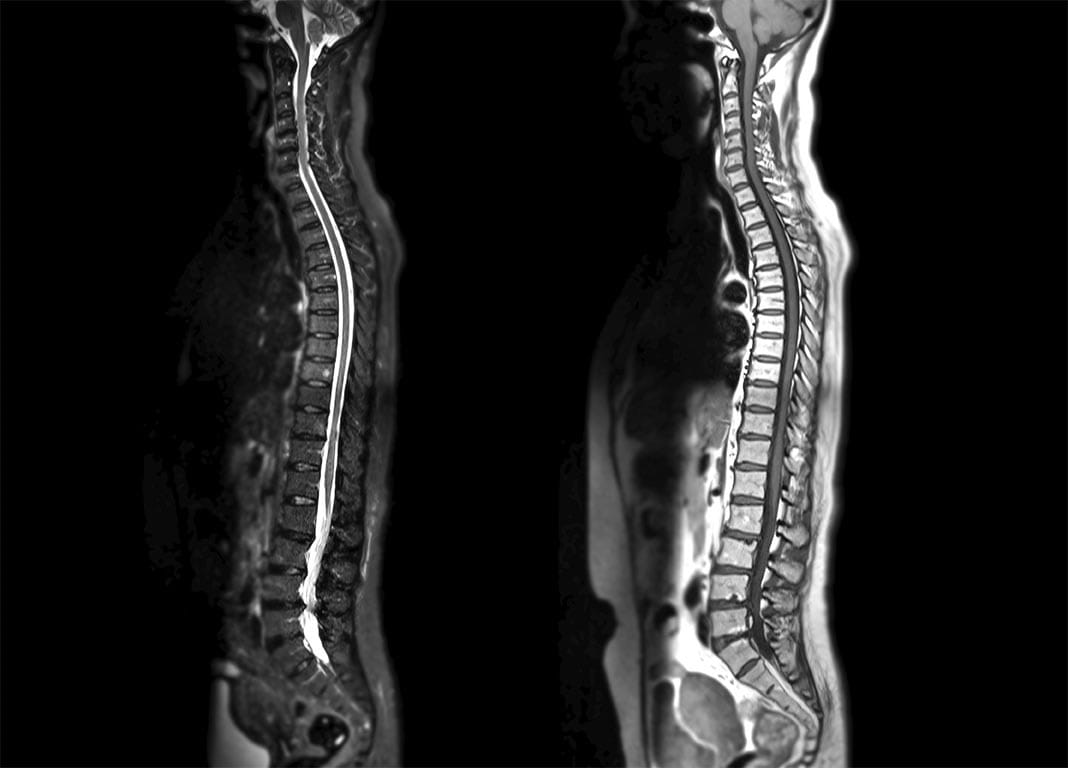 Spine MRI scan showing the vertebrae, discs, and spinal canal